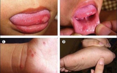 TP.HCM: Dịch bệnh 'hạ nhiệt' khi HS nghỉ hè