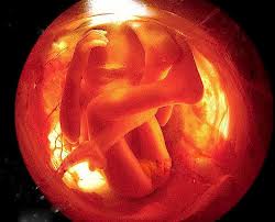 Nước ối của mẹ gây tự kỷ ở trẻ?