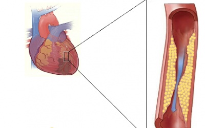 Rối loạn mỡ máu gây nên xơ vữa động mạch