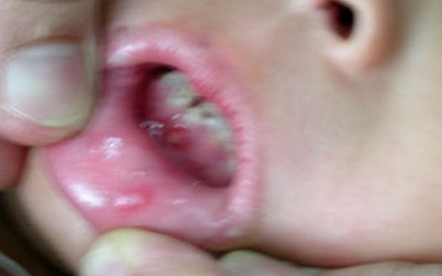 Sởi giảm, bệnh tay chân miệng tăng