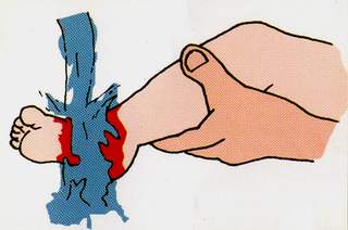 Cách đơn giản xử trí khi trẻ bị bỏng?