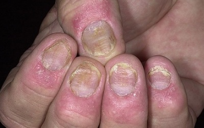 8 nguyên nhân chính gây ra bệnh vẩy nến