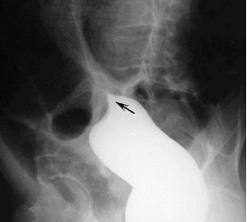 Những điều cần biết về bệnh xoắn đại tràng