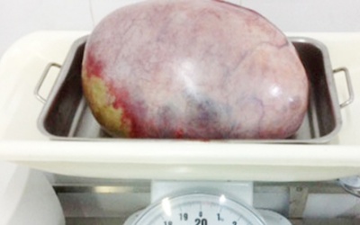 Thiếu nữ chưa chồng bị khối u buồng trứng 5 kg
