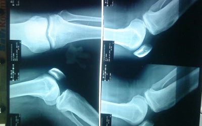 Bệnh viện Chấn thương chỉnh hình phải trả lại tiền 'ăn gian' cho bệnh nhân