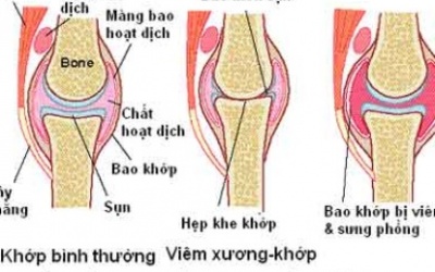 Viêm khớp: Dùng nhiều prednisolon có ảnh hưởng đến sức khỏe?