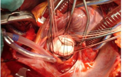 Phẫu thuật tim miễn phí cho người thân cán bộ hải quân, kiểm ngư