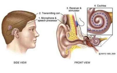 Phát triển công nghệ chụp não cho bệnh nhân cấy ghép ốc tai