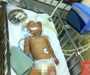 Ngã cầu thang, bé trai 2 tuổi chấn thương sọ não