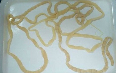 Sán dây 2,5 m sống trong bụng