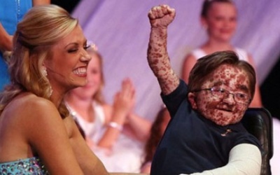 Cậu bé mắc bệnh lạ khiến toàn cơ thể phủ kín các vết chàm