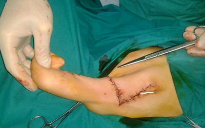 Phẫu thuật di tật thành công cho con trai lính Trường Sa