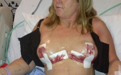 Ngực phát nổ vì bơm silicon nâng cấp vòng một