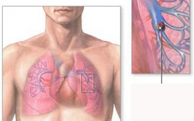 Ghép phổi sau khi bị xơ hóa phổi