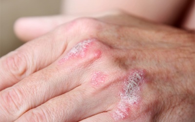Bệnh vảy nến: Không nên dùng thuốc theo kinh nghiệm