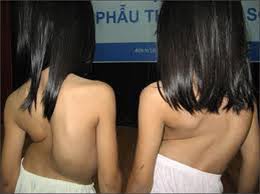 Tìm ra đột biến gen gây gù vẹo cột sống