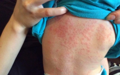 Đã có 146 trẻ em tử vong do dịch sởi