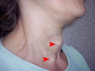 Cần Thơ: Gia tăng các bệnh do thiếu iốt