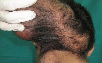 Khối u nặng 1,5kg trên đầu một bệnh nhân