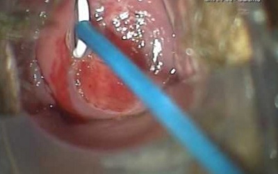 Đốt lộ tuyến có gây khó đậu thai