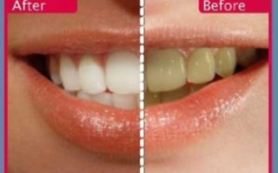 Rước họa vì tẩy trắng răng bằng “thuốc”