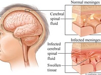 Viêm não Nhật Bản nguy hiểm như thế nào?