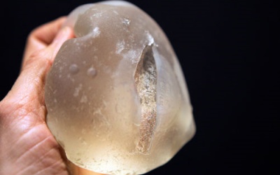 Silicon lỏng vón thành cục cứng trong ngực