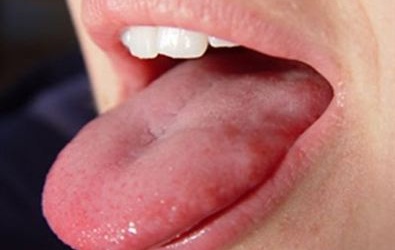 Có phải tôi bị ung thư lưỡi?