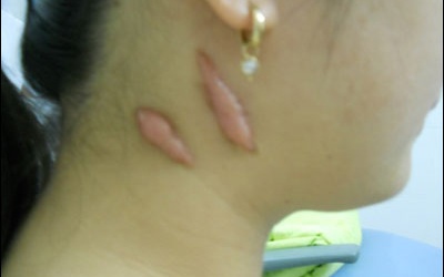 Ðiều trị sẹo lồi thế nào?