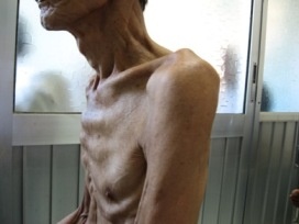 Liên hợp quốc ra kế hoạch xóa bỏ bệnh lao tại hơn 30 quốc gia