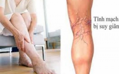 Bệnh suy giãn tĩnh mạch