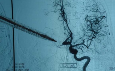 Hồi sinh nhờ phương pháp bít túi phình động mạch não bằng lò xo