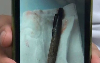 Bút mắc trong bụng suốt 6 tháng