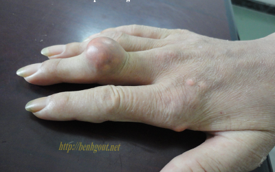 Bệnh gout ở người cao tuổi: Những biến chứng và cách hạn chế