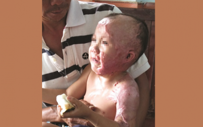 Hạn chế bỏng ở trẻ em
