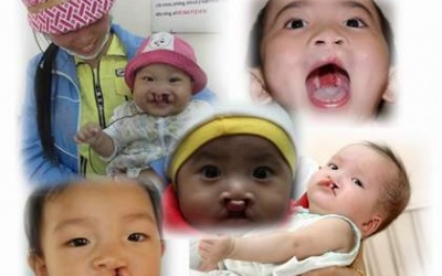 150 trẻ được phẫu thuật hở hàm ếch miễn phí