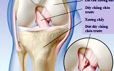 Đứt dây chằng chéo trước: Khi nào cần phẫu thuật?
