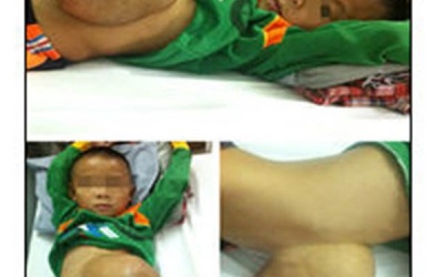 Bé trai phải mang khối thoát vị vùng rốn khổng lồ trong suốt 5 năm