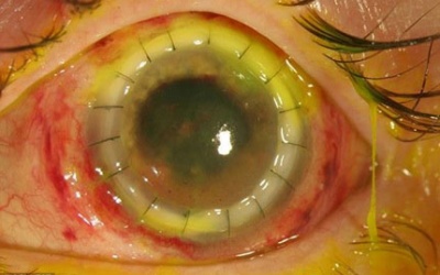 Bị vi khuẩn ăn nhãn cầu vì không vệ sinh kính áp tròng