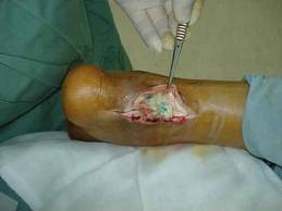 7 trường hợp tử vong vì sử dụng nước bẩn