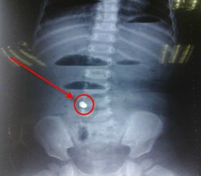 Quảng Bình: Bé trai 3 tuổi nuốt chiếc đinh vít dài 3cm vào trong ổ bụng