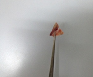 Hóc dị vật ở trẻ: Những điều cha mẹ cần biết