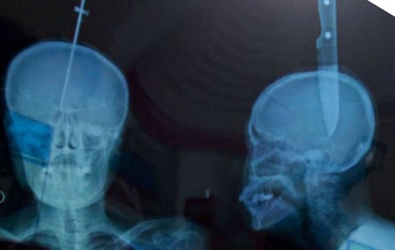 Dao cắm 11cm trên đỉnh đầu vẫn sống