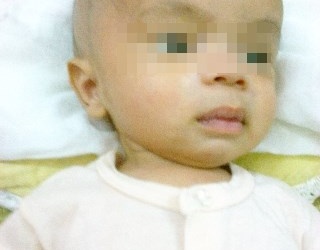 Cứu sống trẻ sơ sinh 18 ngày tuổi bị não úng thủy