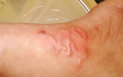 Ăn tái, sống: Khoái khẩu thiệt thân