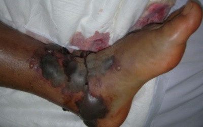 Bé gái suýt mất mạng vì tin thầy lang băm