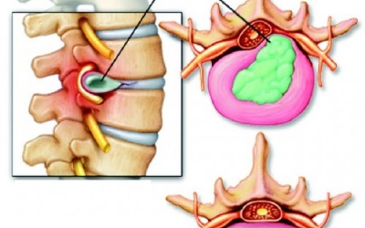 Các dạng biến chứng thoái hóa đốt sống cổ