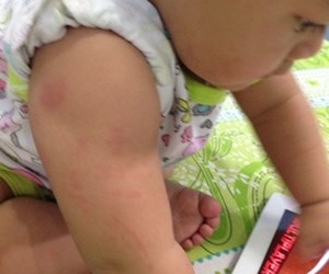 Lại một bé gái nổi mẩn, dị ứng khi dùng sữa Physiolac