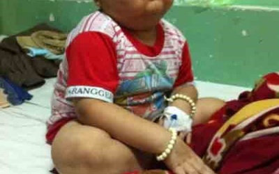 Cháu bé 8 tuổi mắc bệnh xuất huyết tiểu cầu, nát mũi vì phải ăn bằng đường xông