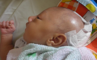 Cứu sống bé 15 ngày tuổi bị thoát vị não, màng não